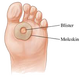 Illustration for article titled Foot Blisters: One Of The Most Exasperating Injuriesem/em